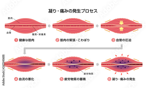 肩こり 凝り 痛みの発生プロセス 6ステップ イラスト Stock Vector Adobe Stock 肩こり 凝り 痛みの発生プロセス 6ステップ イラスト Stock Vector Adobe Stock