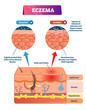 Eczema vector illustration. Labeled anatomical structure comparative scheme