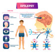 Epilepsy vector illustration. Labeled sick CNS disorder educational scheme.