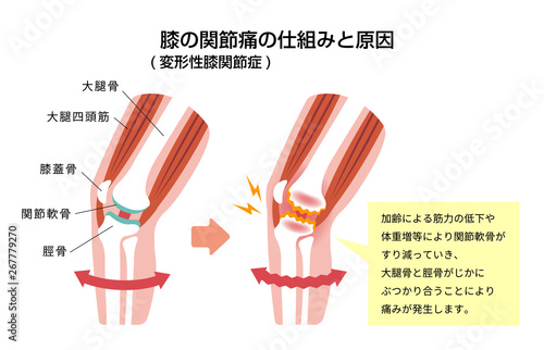膝の関節痛 変形性膝関節症 発生の仕組みと原因 イラスト Stock ベクター Adobe Stock 膝の関節痛 変形性膝関節症 発生の仕組みと原因 イラスト Stock ベクター Adobe Stock