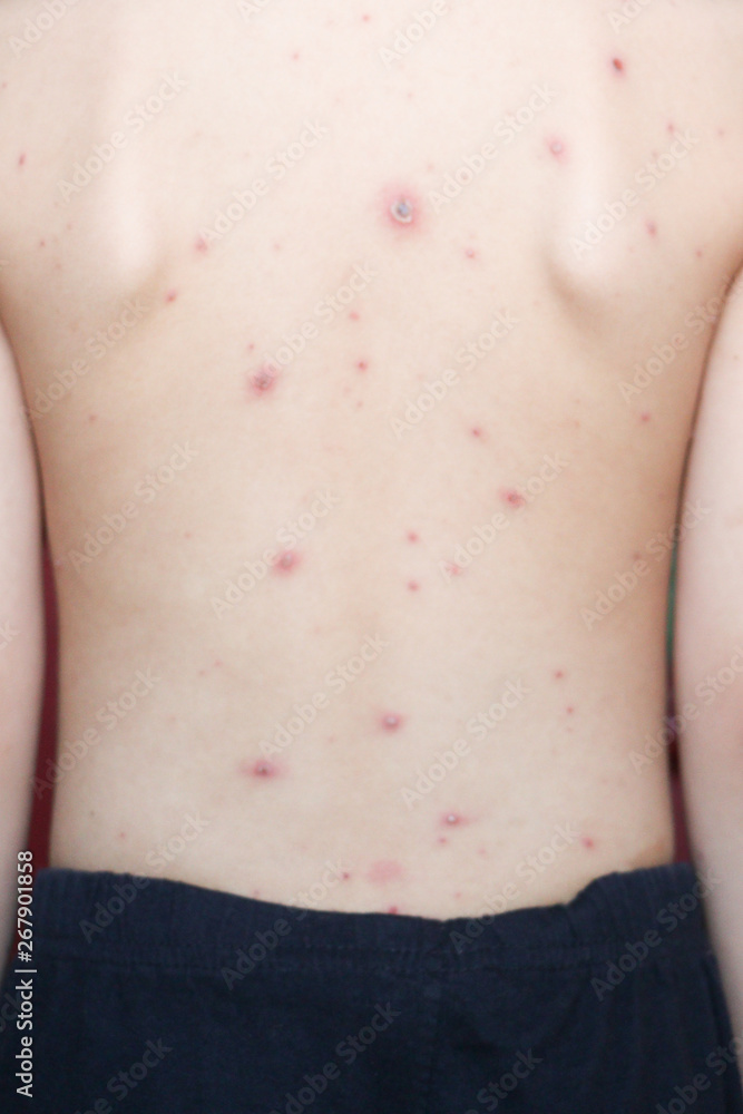 Chicken pox rash on young boy body.Chickenpox is an infection caused by ...