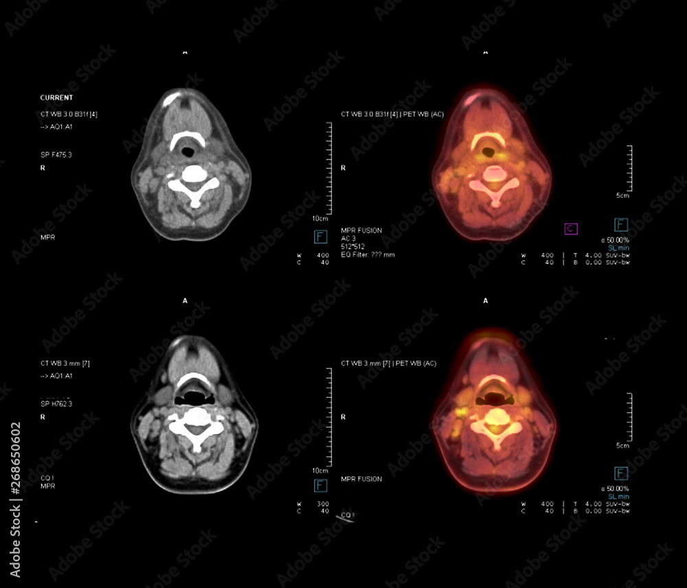 Foto de Stock PET CT Scan image of Neck in axial plane comparison CT ...