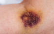 A strong hematoma due to a wrong injection. Concept medical mistakes.