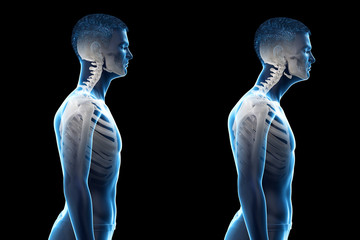 3d rendered medically accurate illustration of a man with a forward head posture