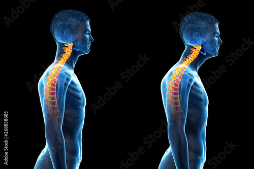 Fotomural 3d rendered medically accurate illustration of a man with a forward head posture