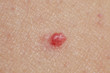 © DBA - Cherry Angiomas on male skin - super macro close up