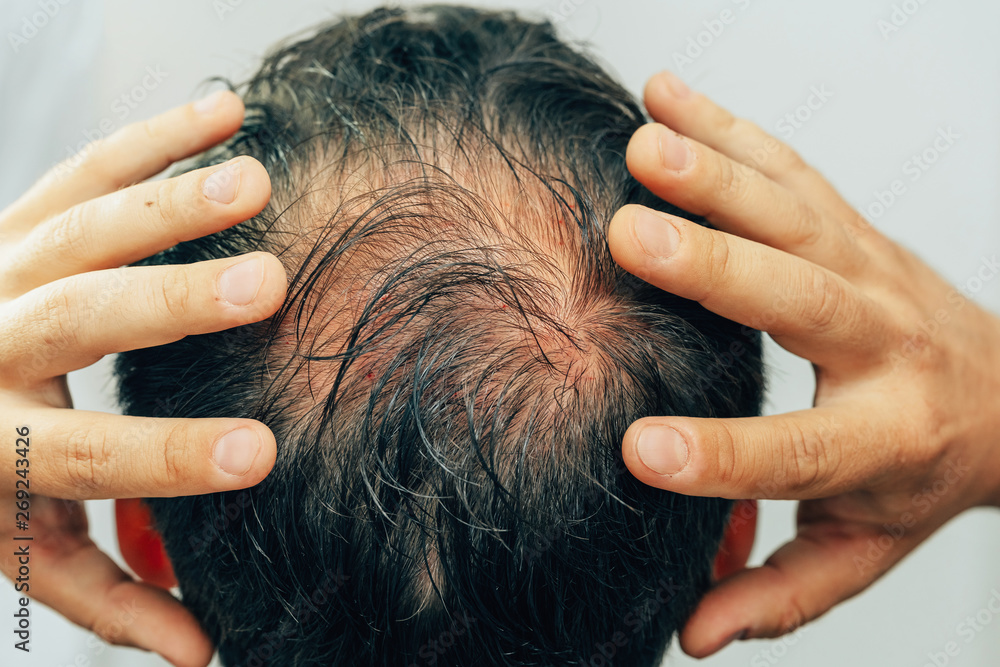 Stock-Foto „Mesotherapy of hair and head. Traces of injections on the ...