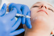 Hyaluronic chin fillers