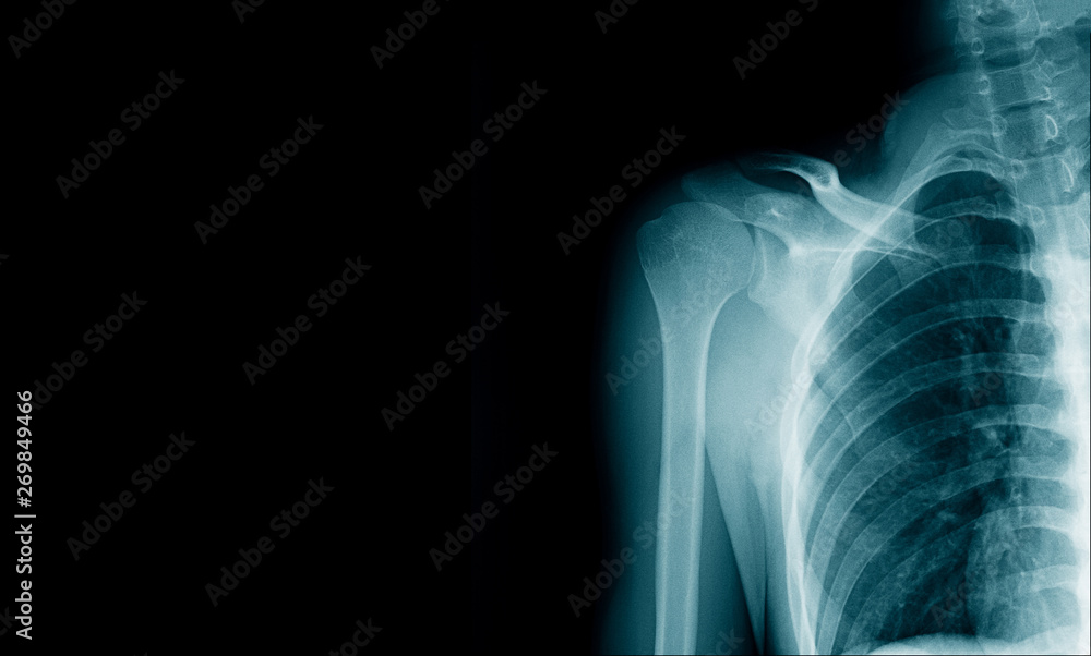 x-ray image clavicle fracture Stock Photo | Adobe Stock