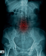 Poster - x-ray image of human spine