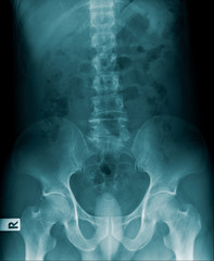 Poster - x-ray image of human spine