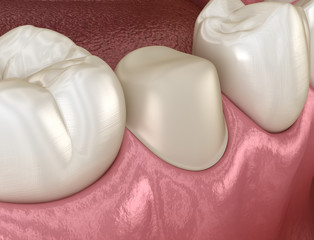 Preparated premolar tooth for dental crown placement. Medically accurate 3D illustration