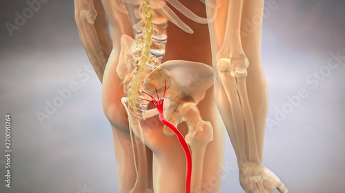 Cuadros en Lienzo Sciatic Pinched Nerve 3D Render