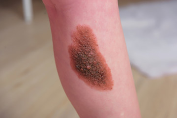 A large birthmark on a person's leg. Pigmented formation on the skin. Benign papilloma