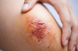 Fresh wound on asian female knee