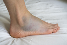 Sprained Ankle With Bruise Adn Swelling, Female Right Foot