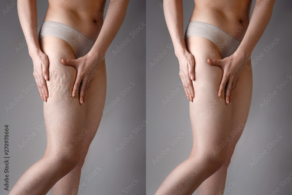 The woman shows cellulite and smooth and delicate skin on her legs. The concept of aesthetic medicine and skin imperfections. Before and after - obrazy, fototapety, plakaty 