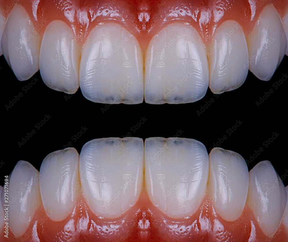 20 unit bl2 color veneers 