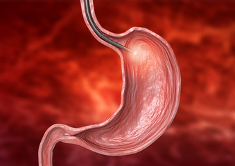 digestive endoscopy - examination using flexible tube with camera and light at its end for diagnosis of diseases of the digestive system