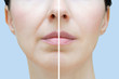 © Iuliia Alekseeva - Nasolabial folds in a Caucasian woman. Face close up. Before and after.