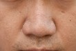 © Thanakon - acne vulgaris on nose of asian man