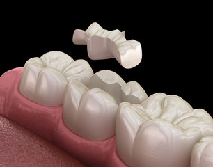 Wall Mural - Inlay ceramic crown fixation over tooth. Medically accurate 3D illustration of human teeth treatment
