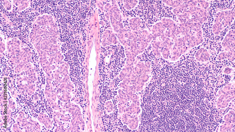 Microscopic image (photomicrograph) of a thymoma, a tumor of thymic ...