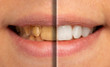 © Alessandro Grandini - A close-up and split view on the mouth of a young Caucasian adult, before and after of cosmetic dentistry whitening procedure, where the teeth are bleached to remove stains.