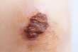 Scar and scab (eschar) on asian female knee