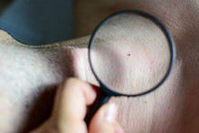 Close Up Of Doctor Dermatologist Examines A Birthmark Of Patient. Checking Benign Moles. Skin Tags Removal. Sun Exposure Effect On Skin, Health Effects Of UV Radiation