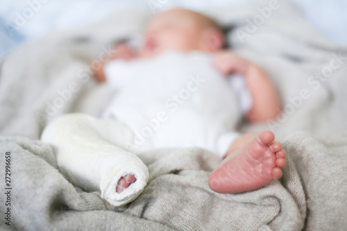 Closeup Of Newborn Little Baby With Leg In A Cast Clubfoot Stock Photo Adobe Stock Closeup Of Newborn Little Baby With Leg In A Cast Clubfoot Stock Photo Adobe Stock