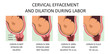 © nmfotograf - Cervix thinning and widening during labor