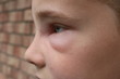 Profile picture of a young boy with swelling of face due to hornet sting