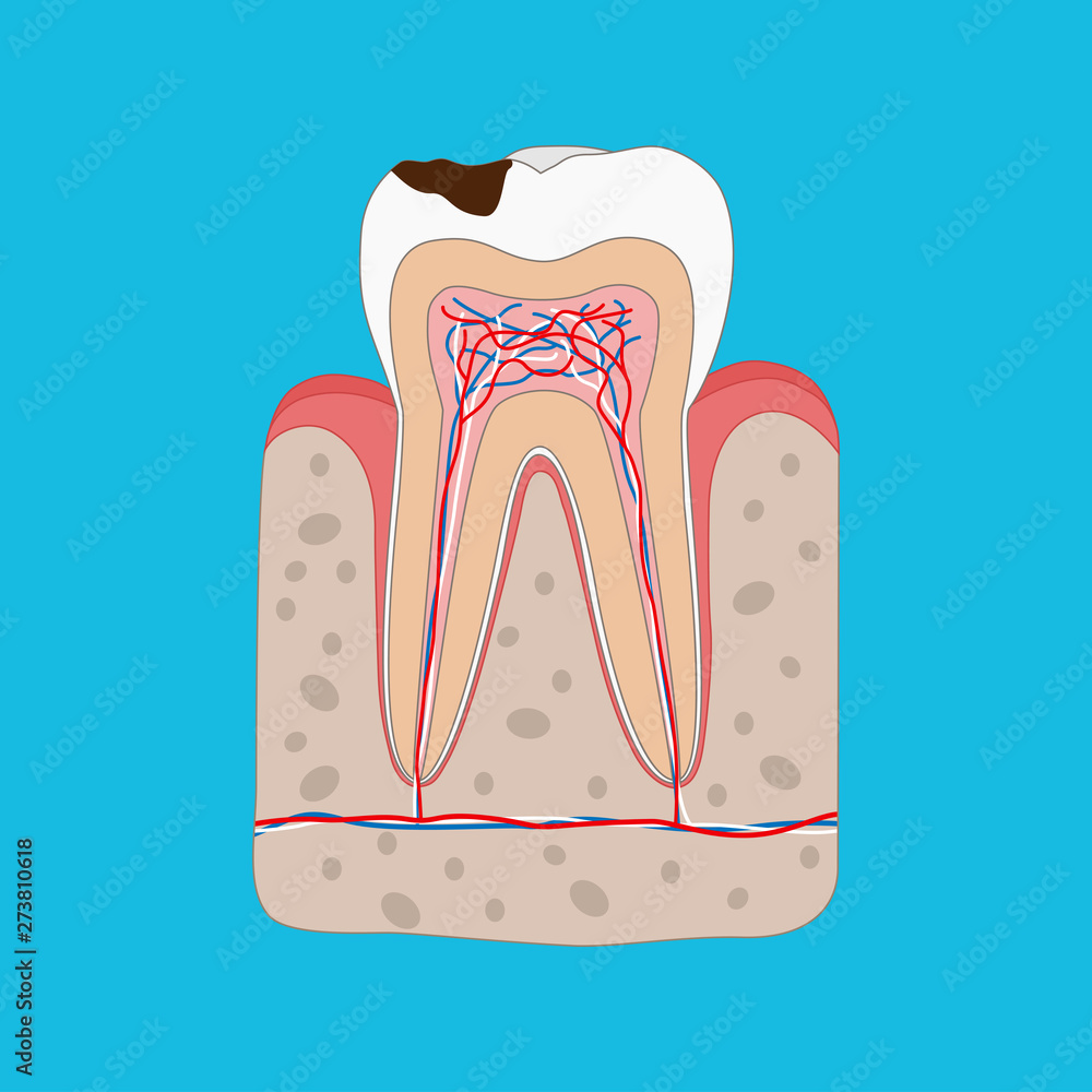 Anatomy of Unhealthy tooth with tooth decay isolated cross section ...