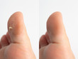© Alessandro Grandini - A closeup view of callus skin on the big toe of a Caucasian person, before and after view isolated against a white background.