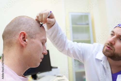 Baldness Treatment Patient Suffering From Hair Loss In