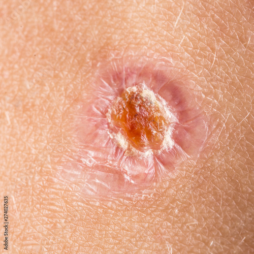 Top 101+ Pictures Pictures Of White Spots On Skin Stunning