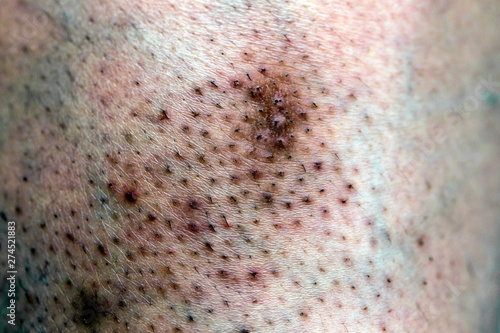 Closeup Of Caucasian Skin With Ingrown Hair Buy This Stock Photo