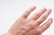 wart on a finger on a white background