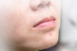 © Khunatorn - Acne pimple on nose in Asian woman skin face close up.