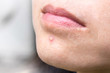 © Khunatorn - Acne pimple on nose in Asian woman skin face close up.