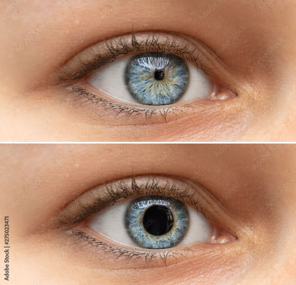 A closeup view on the blue eyes of a pretty young woman. Collage comparing the black pupil, one image shows an enlarged pupil and one shows a reduced pupil. Pupillary light reflex in humans. - obrazy, fototapety, plakaty 