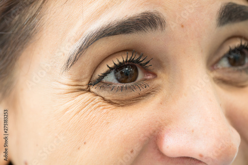 eye side wrinkles