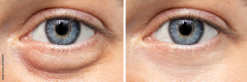 A before and after view on the eyes of a pretty young Caucasian woman, one show puffy dark circles beneath the eye, and the other shows flawless smooth skin after oculoplastic surgery. - obrazy, fototapety, plakaty 