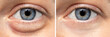 © Alessandro Grandini - A before and after view on the eyes of a pretty young Caucasian woman, one show puffy dark circles beneath the eye, and the other shows flawless smooth skin after oculoplastic surgery.