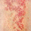 © Volodymyr - Allergic contact dermatitis at shin