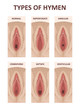 Types of Hymens. Female anatomy vagina