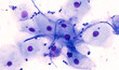 © David A Litman - Endoscopic esophageal brushing cytology showing squamous cells with yeast and pseudohyphae of Candida albicans, a type of fungal infection, from a cancer patient with candidiasis (thrush)