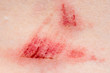 © spyrakot - A wound on the human body. Very close up of painful wound