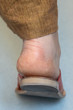 A close up view on the toughened and cracked skin around the heel of a Caucasian woman wearing sandals.